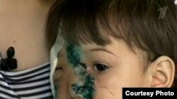 Жамила ит ҳужумидан мўъжиза билан омон қолган бўлса-да¸ унинг юзига етган жароҳатни тузатиш учун жуда кўп пластик операция талаб қилинади.